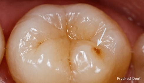 Ząb trzonowy z niewielką brązową plamką na powierzchni żującej