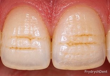 Dwa górne siekacze z poziomymi bruzdami i żółtawymi liniami w szkliwie