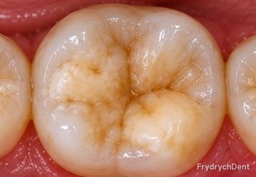Ząb trzonowy widziany od strony żującej, z kremowymi i żółtobrązowymi plamami na guzkach